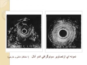 سونوگرافی آندو آنال و آندو رکتال