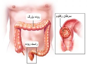سرطان رکتوم یا راست روده