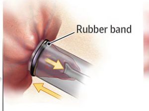 Treatment of hemorrhoids with rubber band