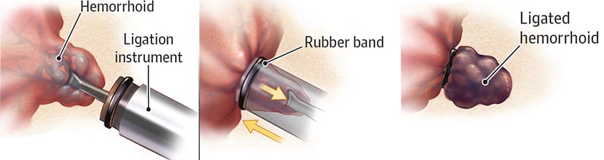 Treatment of hemorrhoids with rubber band