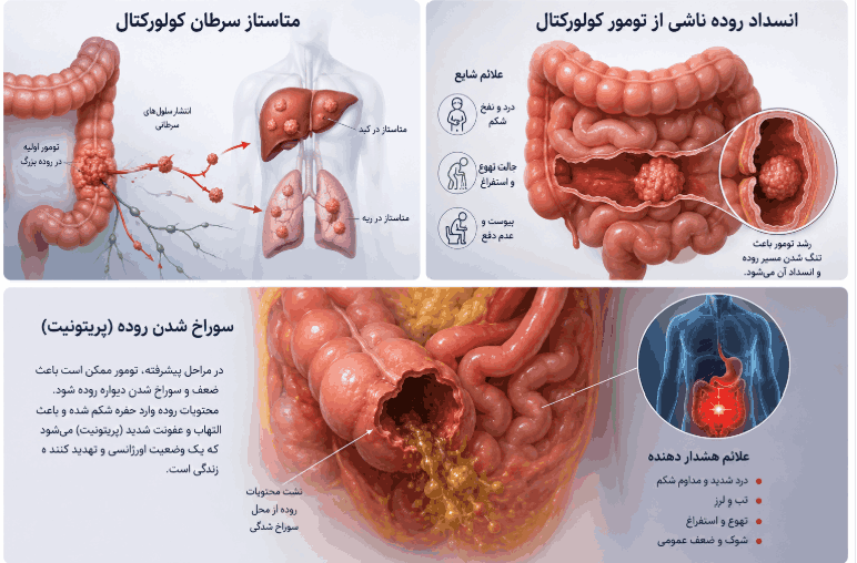 پیامدها و عوارض عدم درمان سرطان روده بزرگ و رکتوم عوارض عدم درمان سرطان روده بزرگ