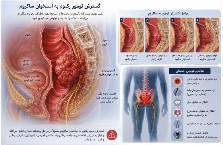 پیامدها و عوارض عدم درمان سرطان روده بزرگ و رکتوم عوارض سرطان روده بزرگ