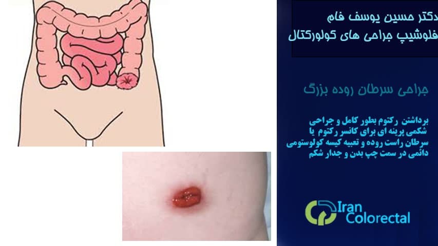 جراحی سرطان رکتوم