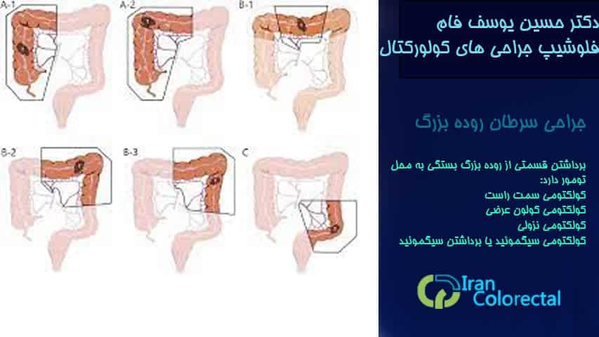 جراحی سرطان کولون