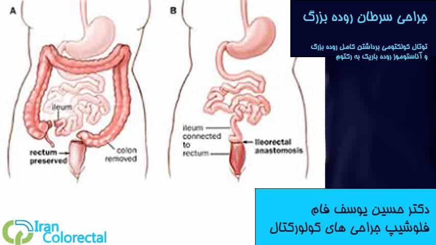 جراحی توتال کولکتومی